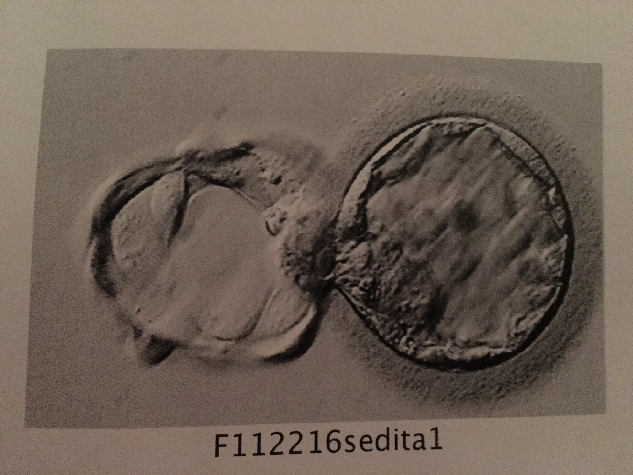 Photo of our embryo in its blastocyst stage